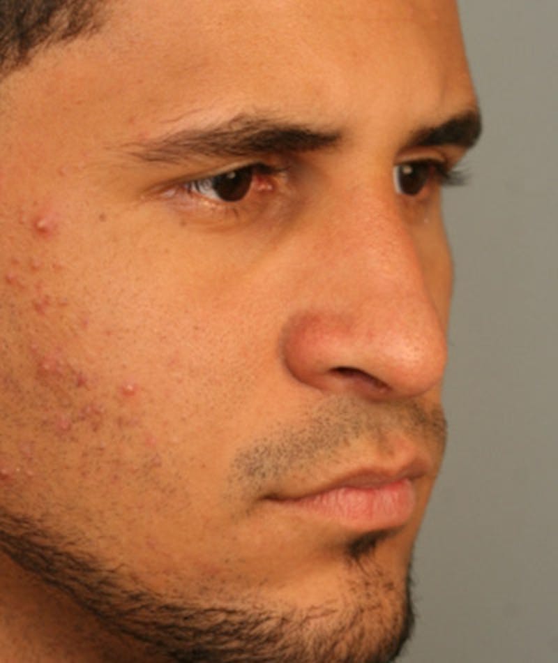 Primary Rhinoplasty Before & After Gallery - Patient 108174264 - Image 6