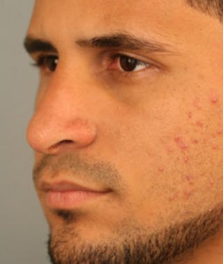 Primary Rhinoplasty Before & After Gallery - Patient 108174264 - Image 8