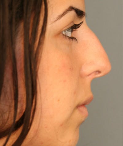 Primary Rhinoplasty Before & After Gallery - Patient 108174271 - Image 1