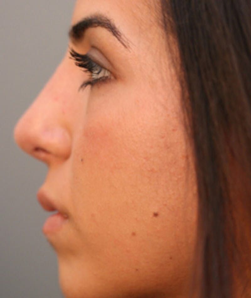 Primary Rhinoplasty Before & After Gallery - Patient 108174271 - Image 2