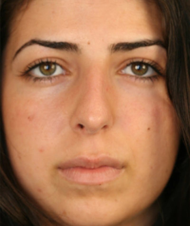 Primary Rhinoplasty Before & After Gallery - Patient 108174271 - Image 3