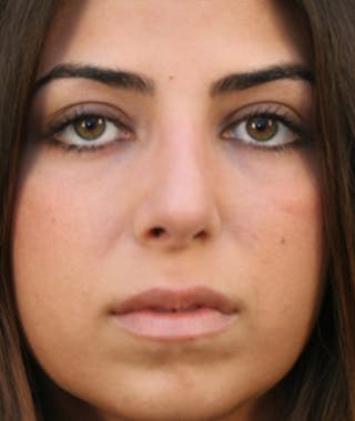 Primary Rhinoplasty Before & After Gallery - Patient 108174271 - Image 4