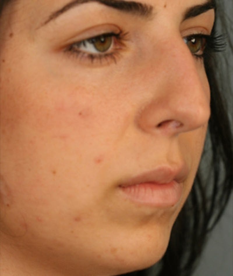 Primary Rhinoplasty Before & After Gallery - Patient 108174271 - Image 5