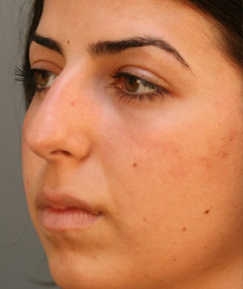 Primary Rhinoplasty Before & After Gallery - Patient 108174271 - Image 7