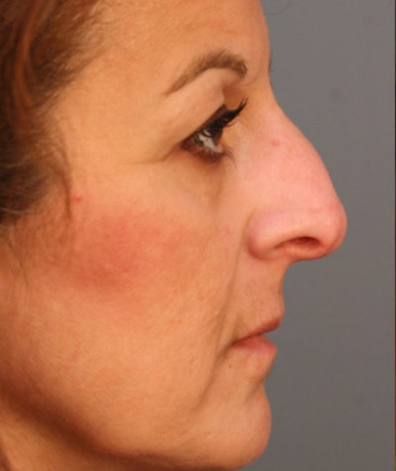 Primary Rhinoplasty Before & After Gallery - Patient 108174275 - Image 1