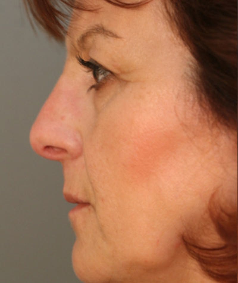 Primary Rhinoplasty Before & After Gallery - Patient 108174275 - Image 2