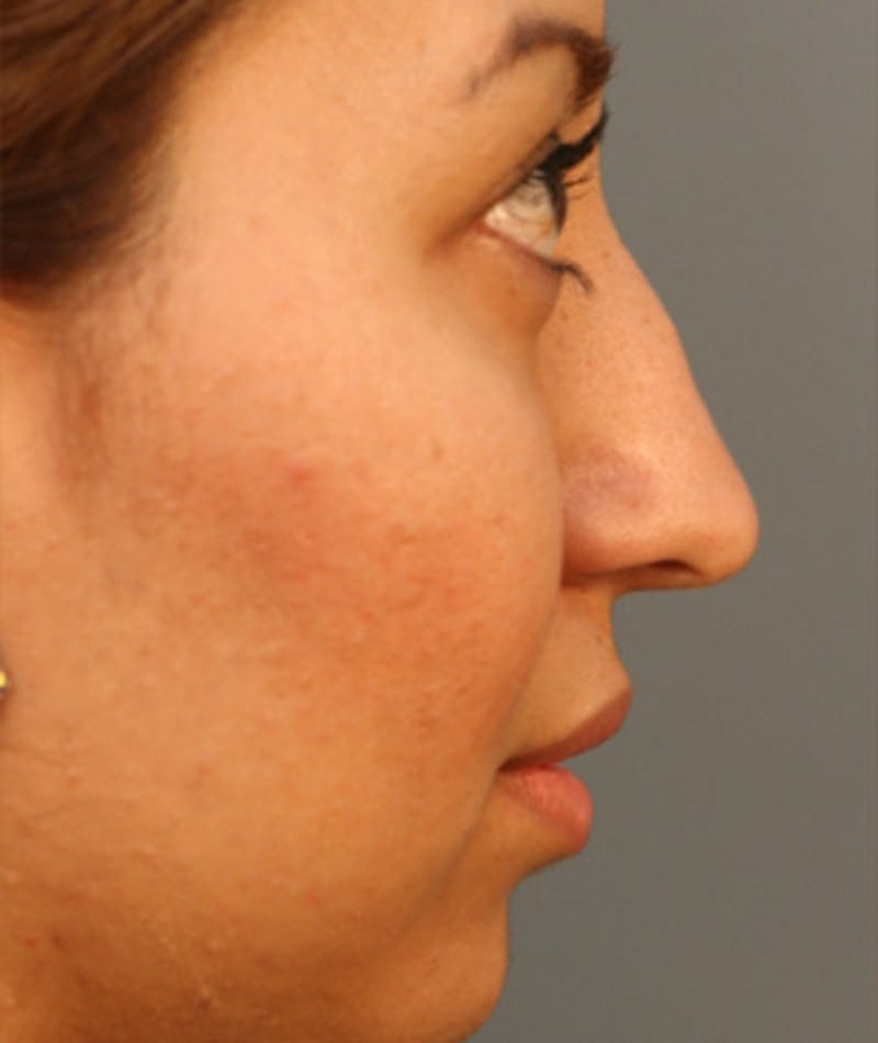 Primary Rhinoplasty Before & After Gallery - Patient 108174284 - Image 1