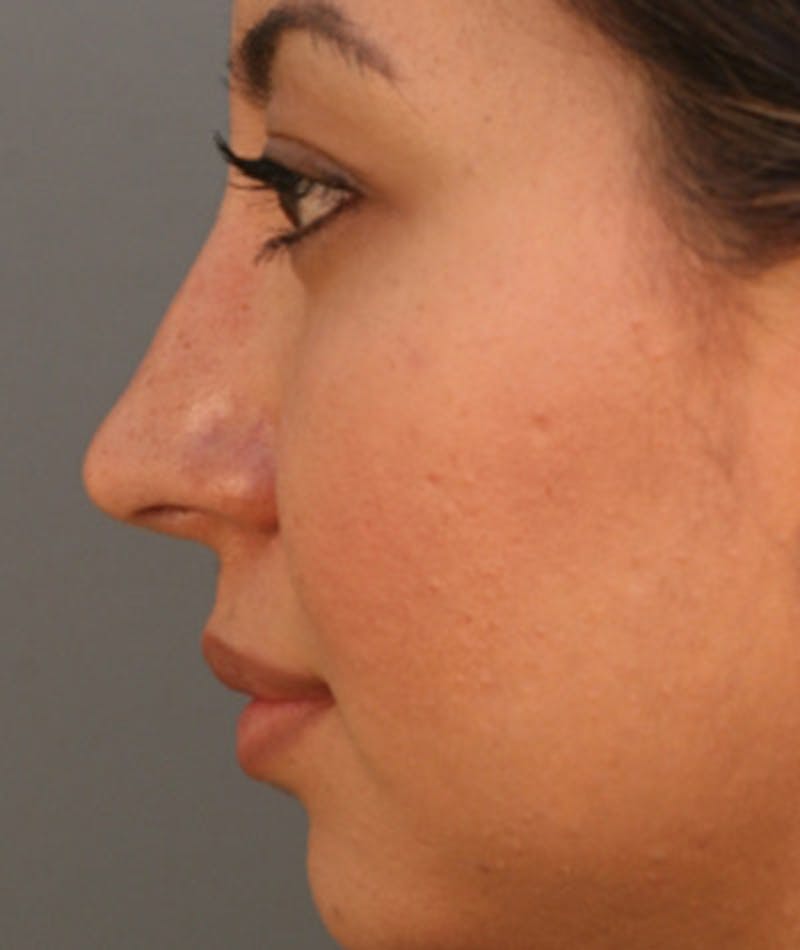 Primary Rhinoplasty Before & After Gallery - Patient 108174284 - Image 2