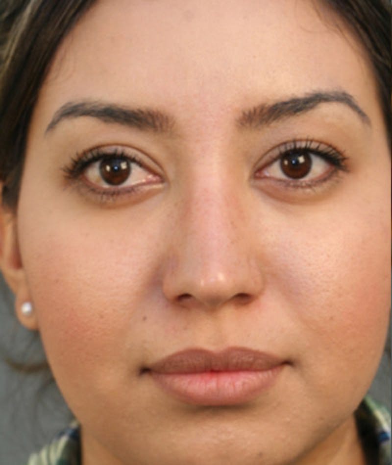 Primary Rhinoplasty Before & After Gallery - Patient 108174284 - Image 4