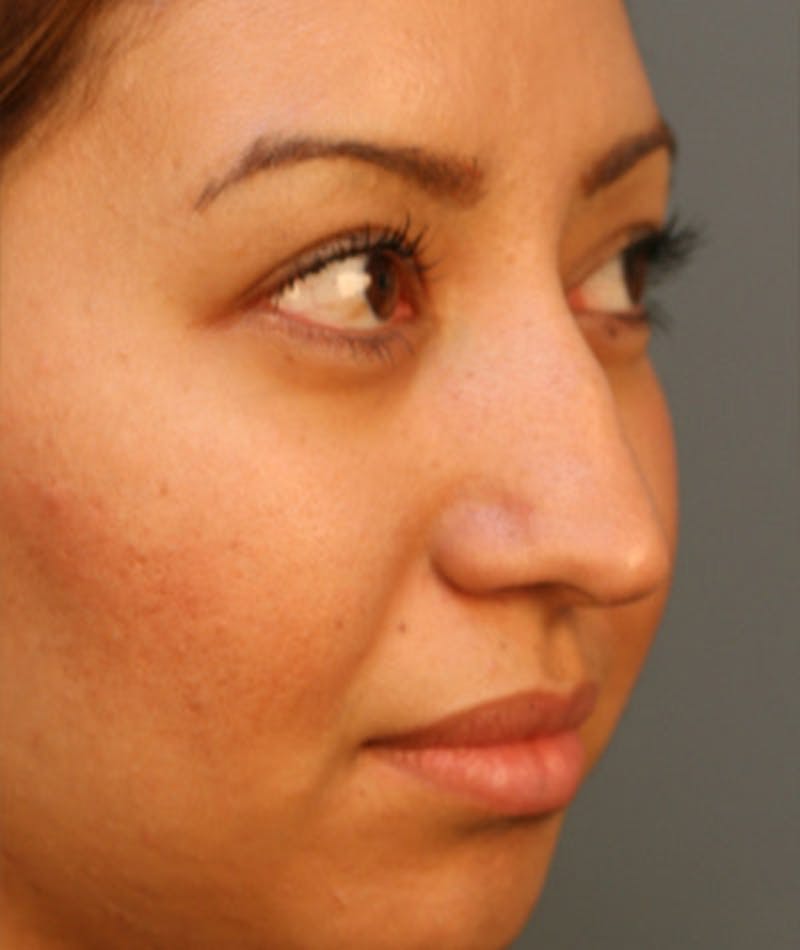 Primary Rhinoplasty Before & After Gallery - Patient 108174284 - Image 5