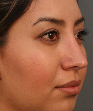 Primary Rhinoplasty Before & After Gallery - Patient 108174284 - Image 6