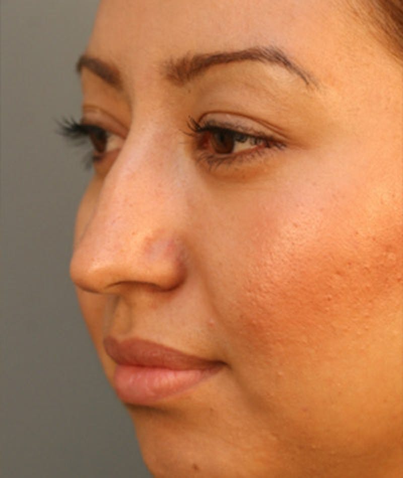 Primary Rhinoplasty Before & After Gallery - Patient 108174284 - Image 7