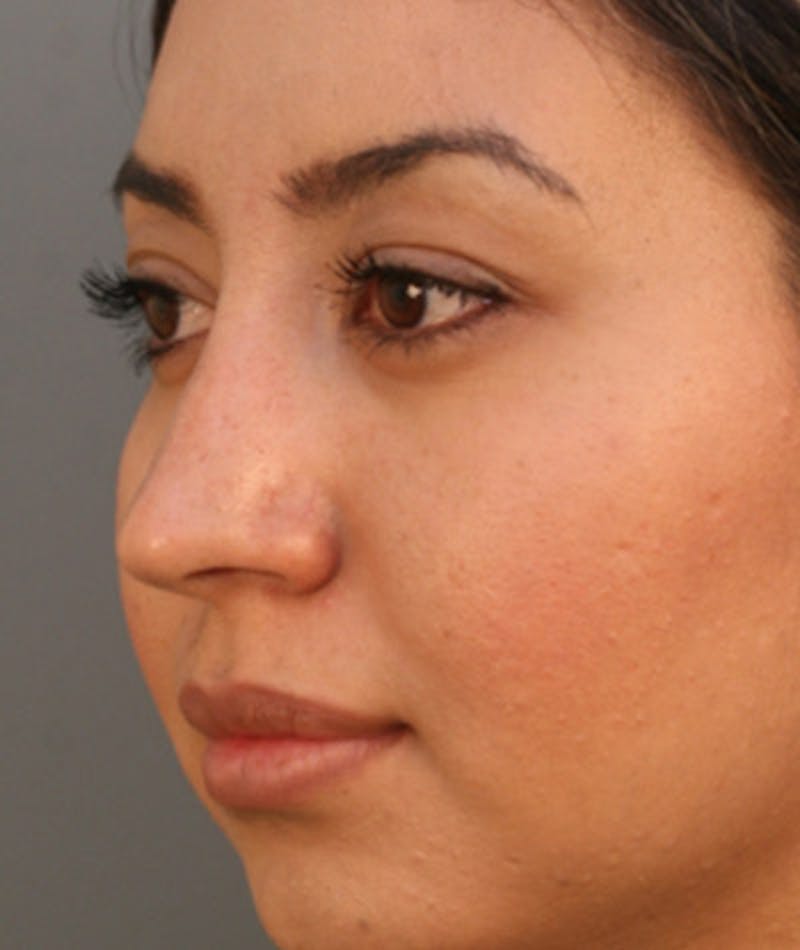 Primary Rhinoplasty Before & After Gallery - Patient 108174284 - Image 8