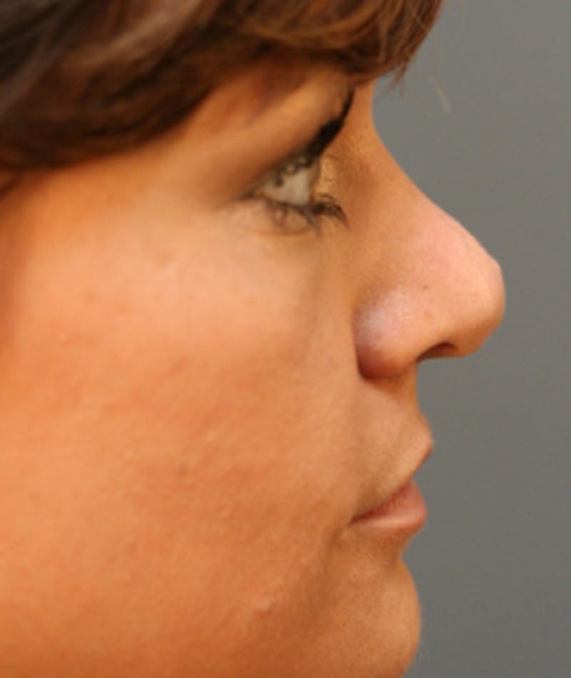 Primary Rhinoplasty Before & After Gallery - Patient 108174285 - Image 1