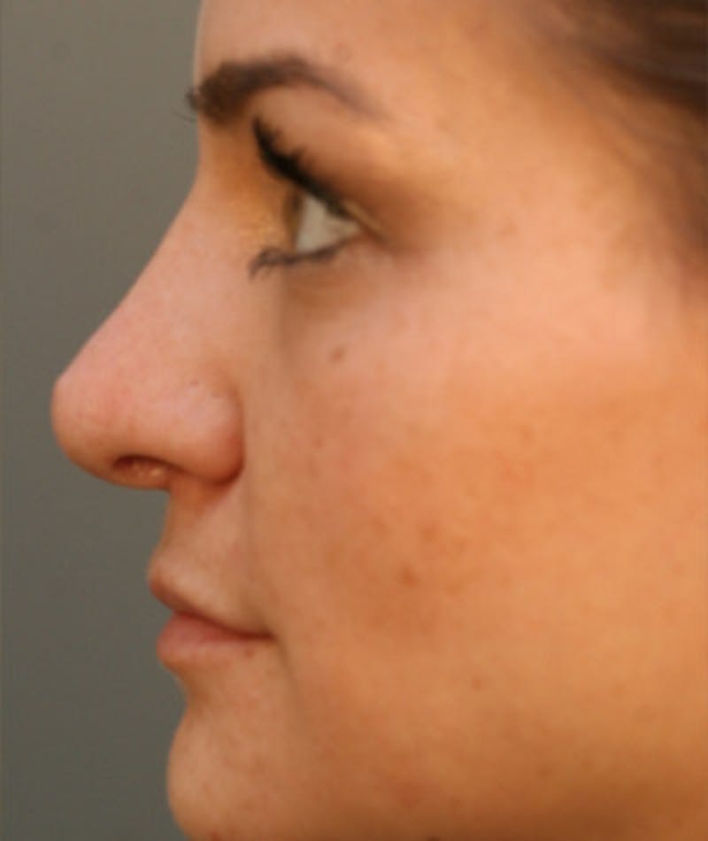 Primary Rhinoplasty Before & After Gallery - Patient 108174285 - Image 2
