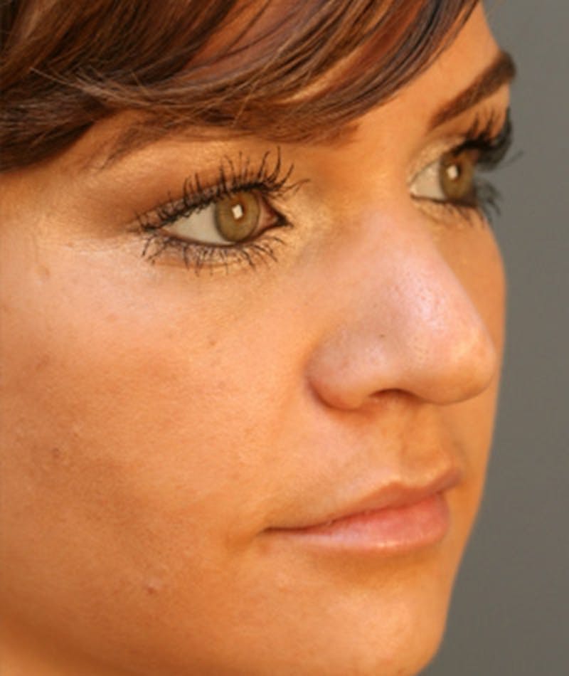 Primary Rhinoplasty Before & After Gallery - Patient 108174285 - Image 3