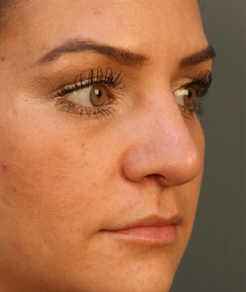 Primary Rhinoplasty Before & After Gallery - Patient 108174285 - Image 4