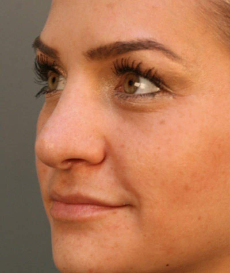 Primary Rhinoplasty Before & After Gallery - Patient 108174285 - Image 6