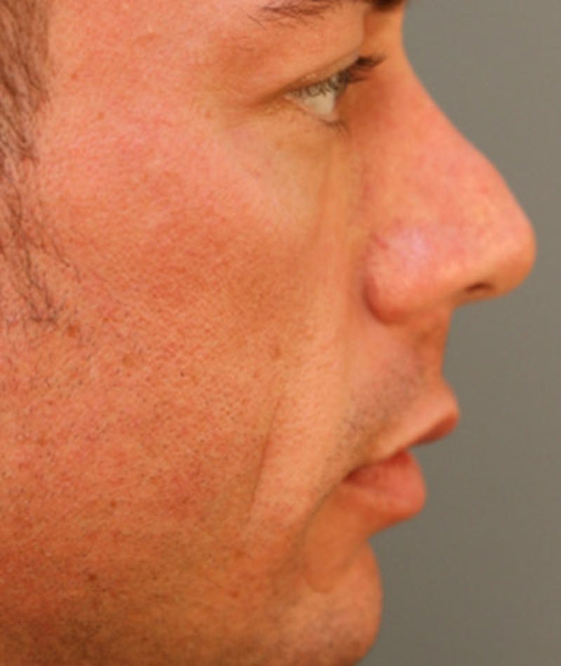 Primary Rhinoplasty Before & After Gallery - Patient 108174318 - Image 1