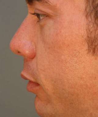 Primary Rhinoplasty Before & After Gallery - Patient 108174318 - Image 2