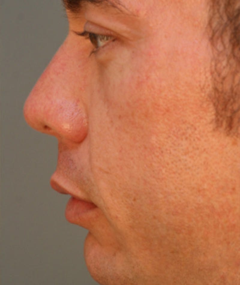 Primary Rhinoplasty Before & After Gallery - Patient 108174318 - Image 2
