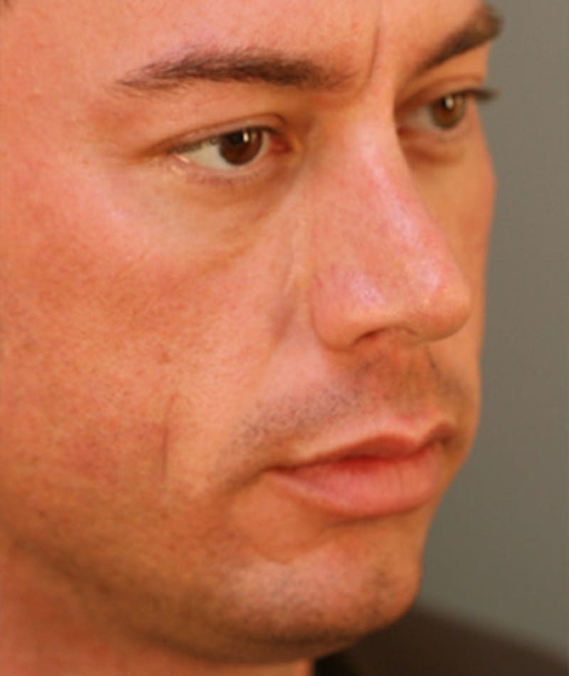 Primary Rhinoplasty Before & After Gallery - Patient 108174318 - Image 3
