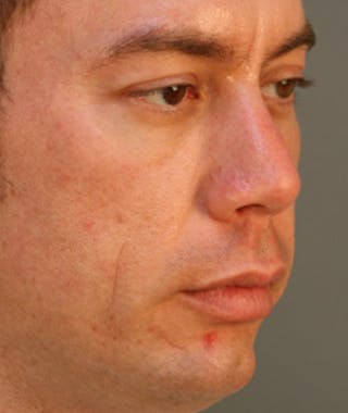 Primary Rhinoplasty Before & After Gallery - Patient 108174318 - Image 4