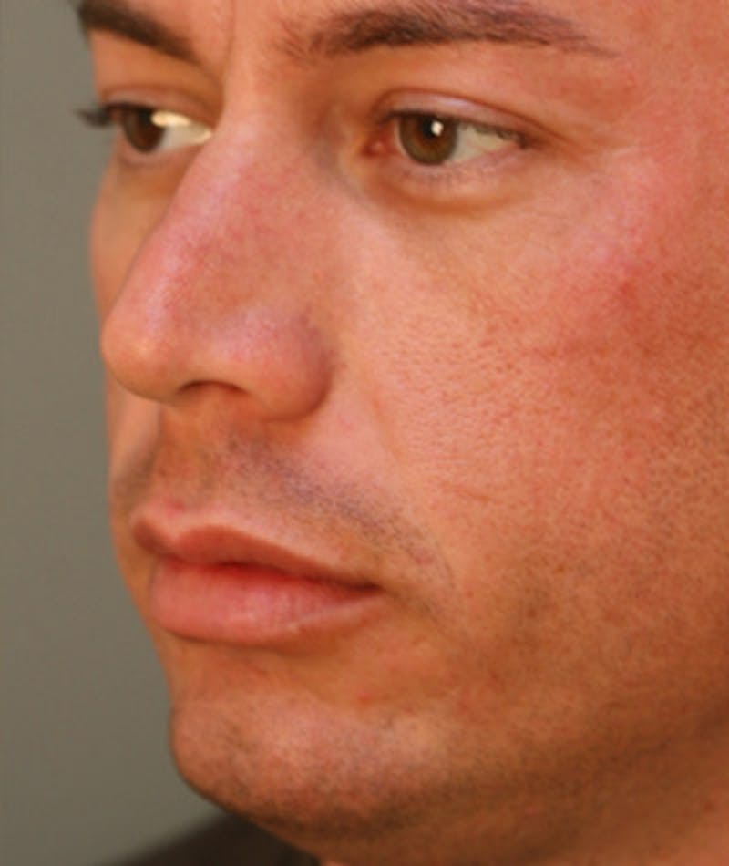 Primary Rhinoplasty Before & After Gallery - Patient 108174318 - Image 5
