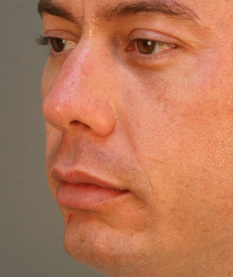 Primary Rhinoplasty Before & After Gallery - Patient 108174318 - Image 6