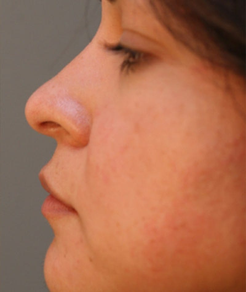 Primary Rhinoplasty Before & After Gallery - Patient 108174319 - Image 2