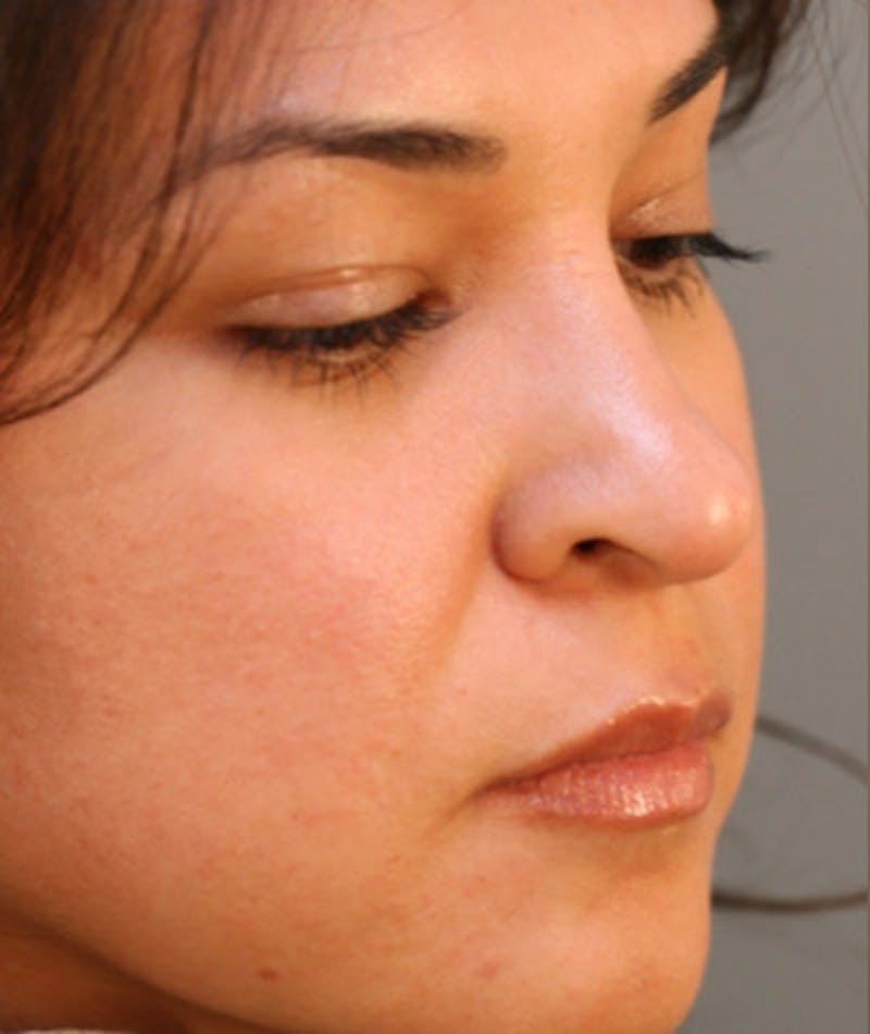 Primary Rhinoplasty Before & After Gallery - Patient 108174319 - Image 4