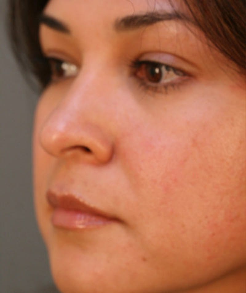 Primary Rhinoplasty Before & After Gallery - Patient 108174319 - Image 6