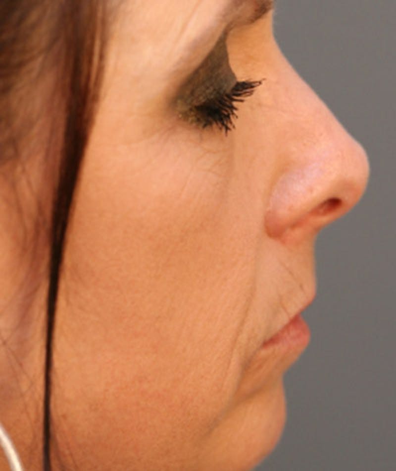 Primary Rhinoplasty Before & After Gallery - Patient 108174320 - Image 1