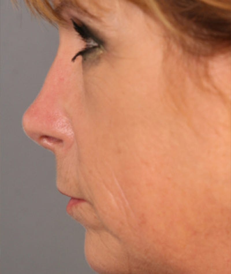 Primary Rhinoplasty Before & After Gallery - Patient 108174320 - Image 2