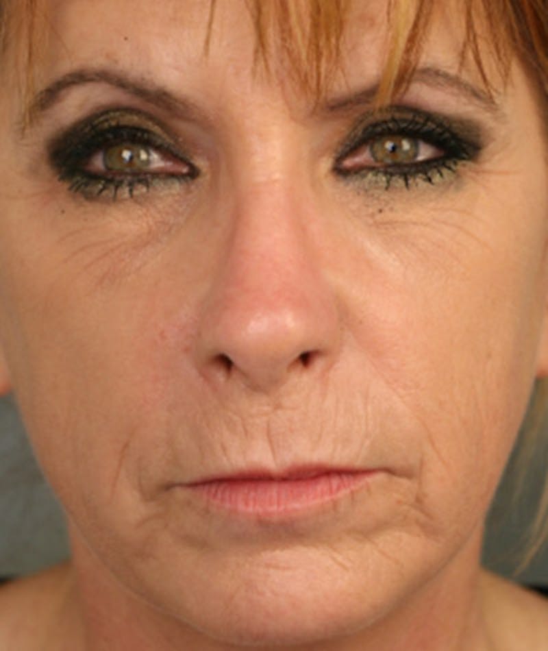 Primary Rhinoplasty Before & After Gallery - Patient 108174320 - Image 4