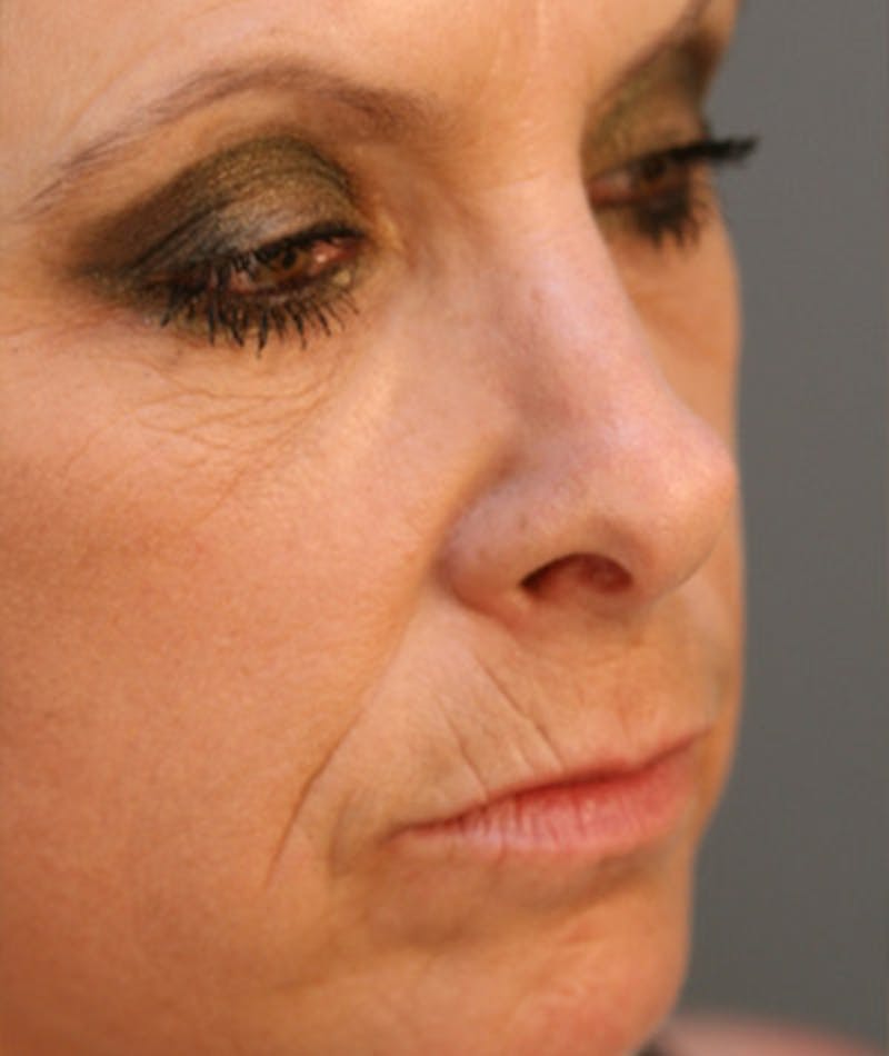 Primary Rhinoplasty Before & After Gallery - Patient 108174320 - Image 5