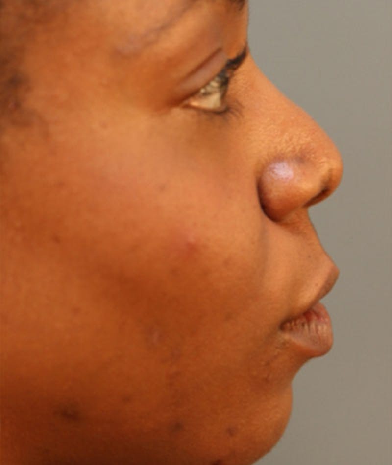 Primary Rhinoplasty Before & After Gallery - Patient 108174321 - Image 1