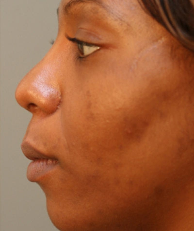 Primary Rhinoplasty Before & After Gallery - Patient 108174321 - Image 2