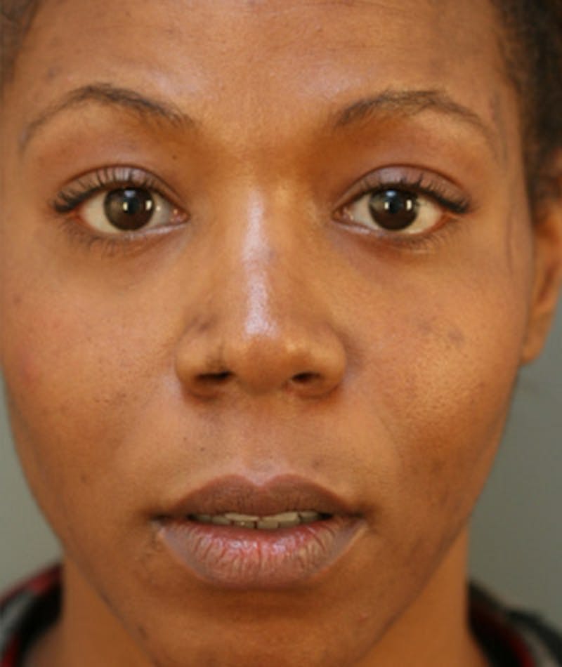 Primary Rhinoplasty Before & After Gallery - Patient 108174321 - Image 3
