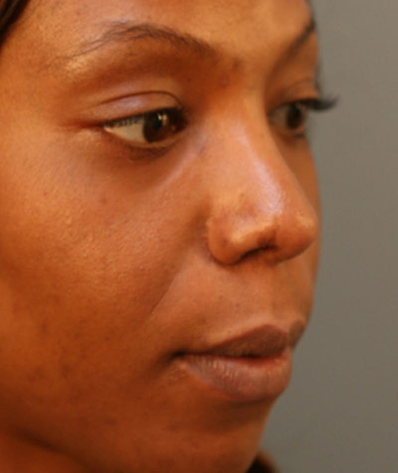 Primary Rhinoplasty Before & After Gallery - Patient 108174321 - Image 6