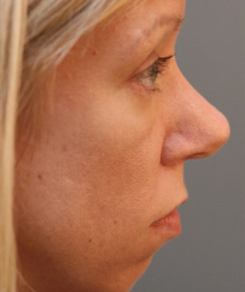 Primary Rhinoplasty Before & After Gallery - Patient 108174322 - Image 1