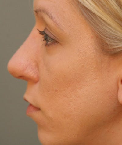 Primary Rhinoplasty Before & After Gallery - Patient 108174322 - Image 2