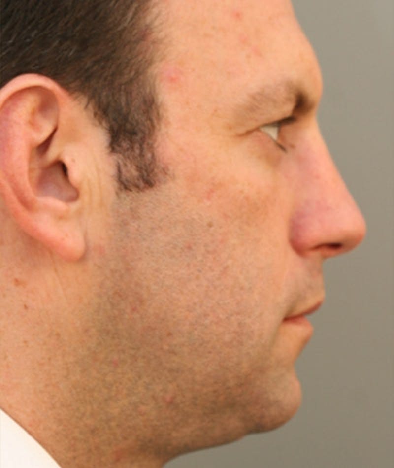 Primary Rhinoplasty Before & After Gallery - Patient 108174323 - Image 1