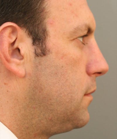 Primary Rhinoplasty Before & After Gallery - Patient 108174323 - Image 1