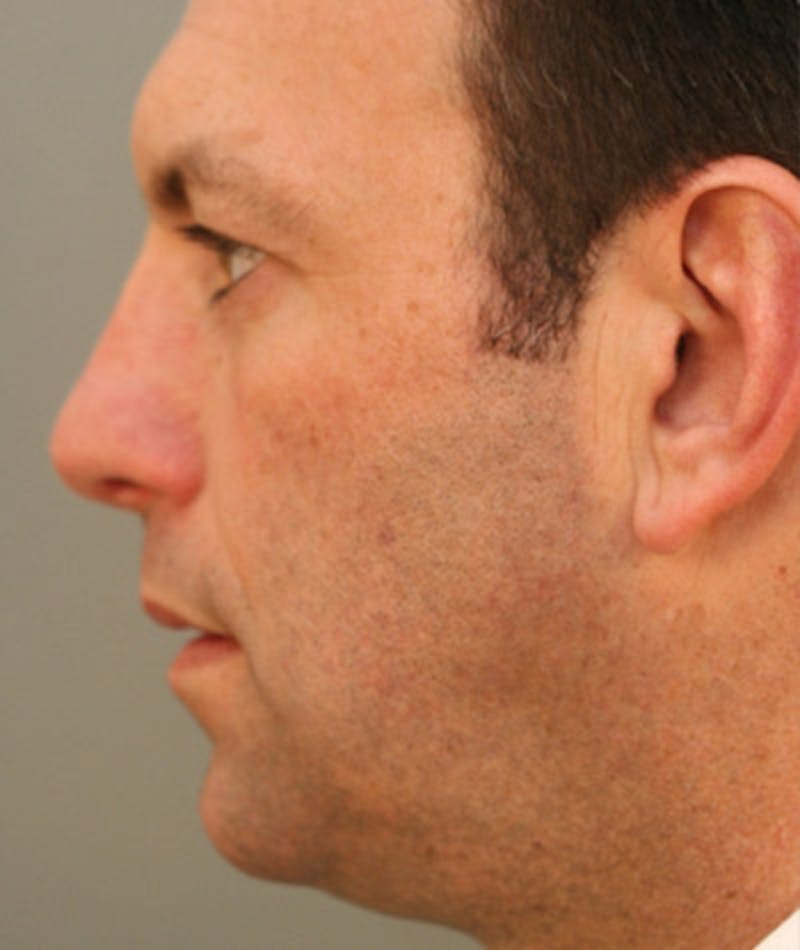 Primary Rhinoplasty Before & After Gallery - Patient 108174323 - Image 2