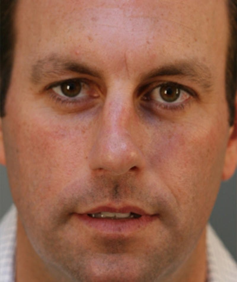 Primary Rhinoplasty Before & After Gallery - Patient 108174323 - Image 3