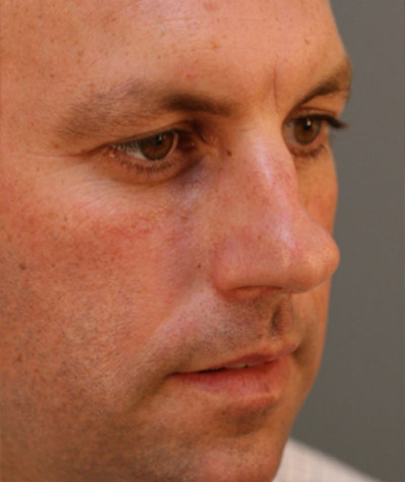 Primary Rhinoplasty Before & After Gallery - Patient 108174323 - Image 5