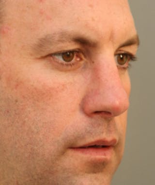 Primary Rhinoplasty Before & After Gallery - Patient 108174323 - Image 6