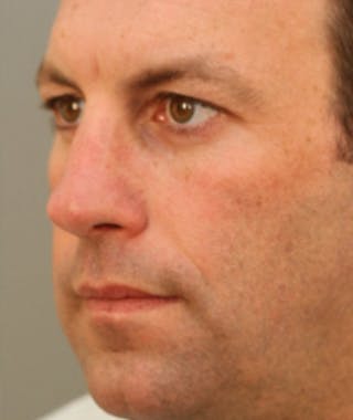 Primary Rhinoplasty Before & After Gallery - Patient 108174323 - Image 8