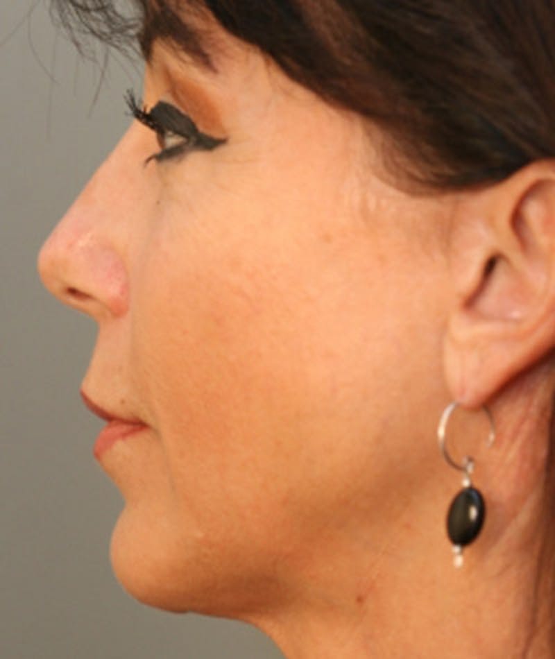 Primary Rhinoplasty Before & After Gallery - Patient 108174324 - Image 2